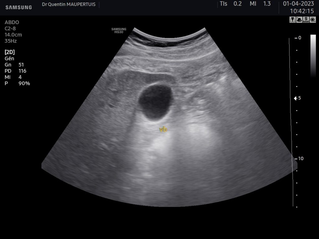 Échographie de la vésicule et des voies biliaires. – Échoclic