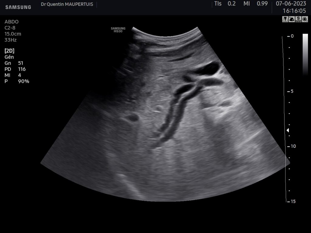 Échographie de la vésicule et des voies biliaires. – Échoclic