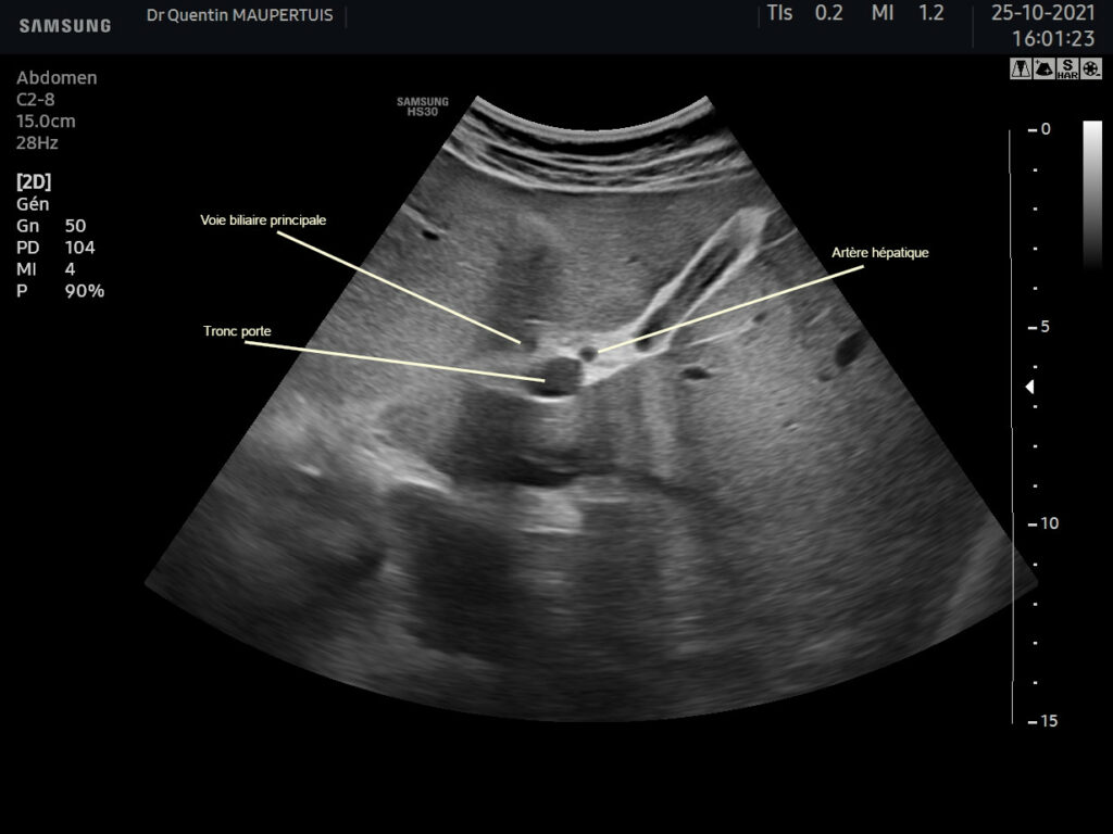 Échographie de la vésicule et des voies biliaires. – Échoclic